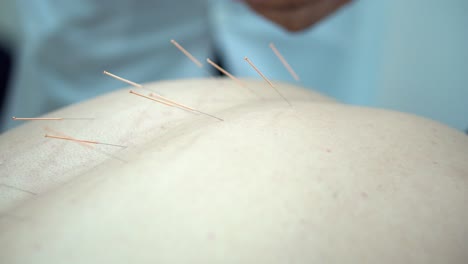 acupuncture treatment session