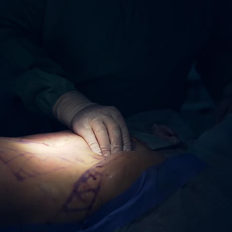 abdominal liposuction. surgeons hands pumping fat from patient's belly. spot of operation. removing fat during liposuction. close-up