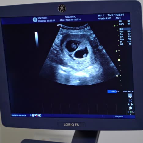 ultrasound procedure of human heart