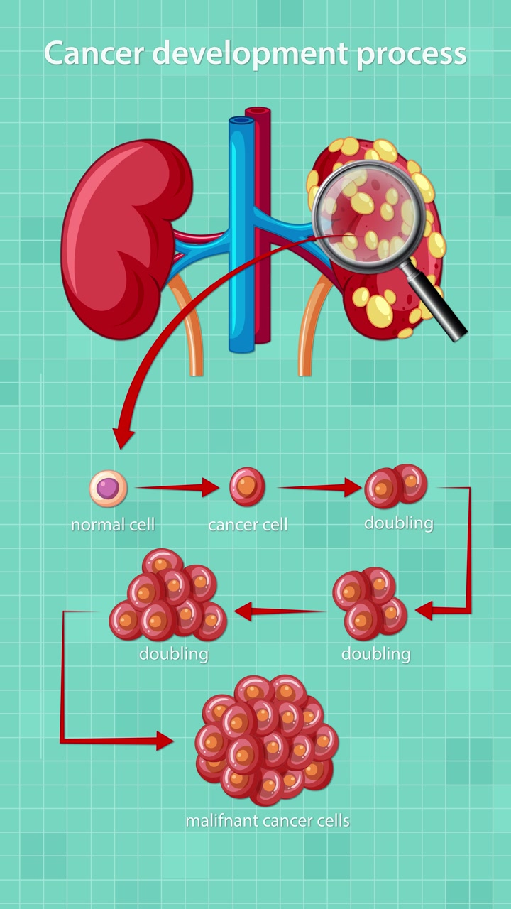 Medical animation illustrating kidney cancer progression, highlighting cellular transformation, abnormal cell doubling, and tumor formation with clear, step-by-step visual transitions