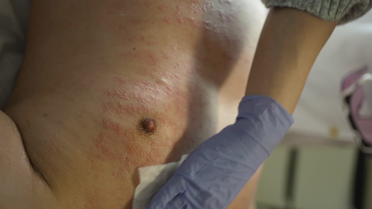 레이저 제거 후 피부 청소