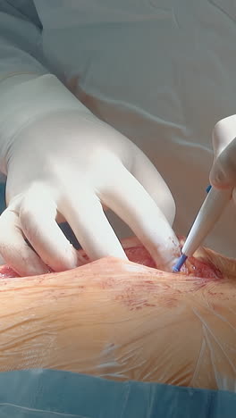 el cirujano corta los tejidos internos del cuerpo con un bisturí láser de cerca. el cardiólogo experto utiliza un instrumento de alta precisión para la cirugía de derivación de la arteria coronaria