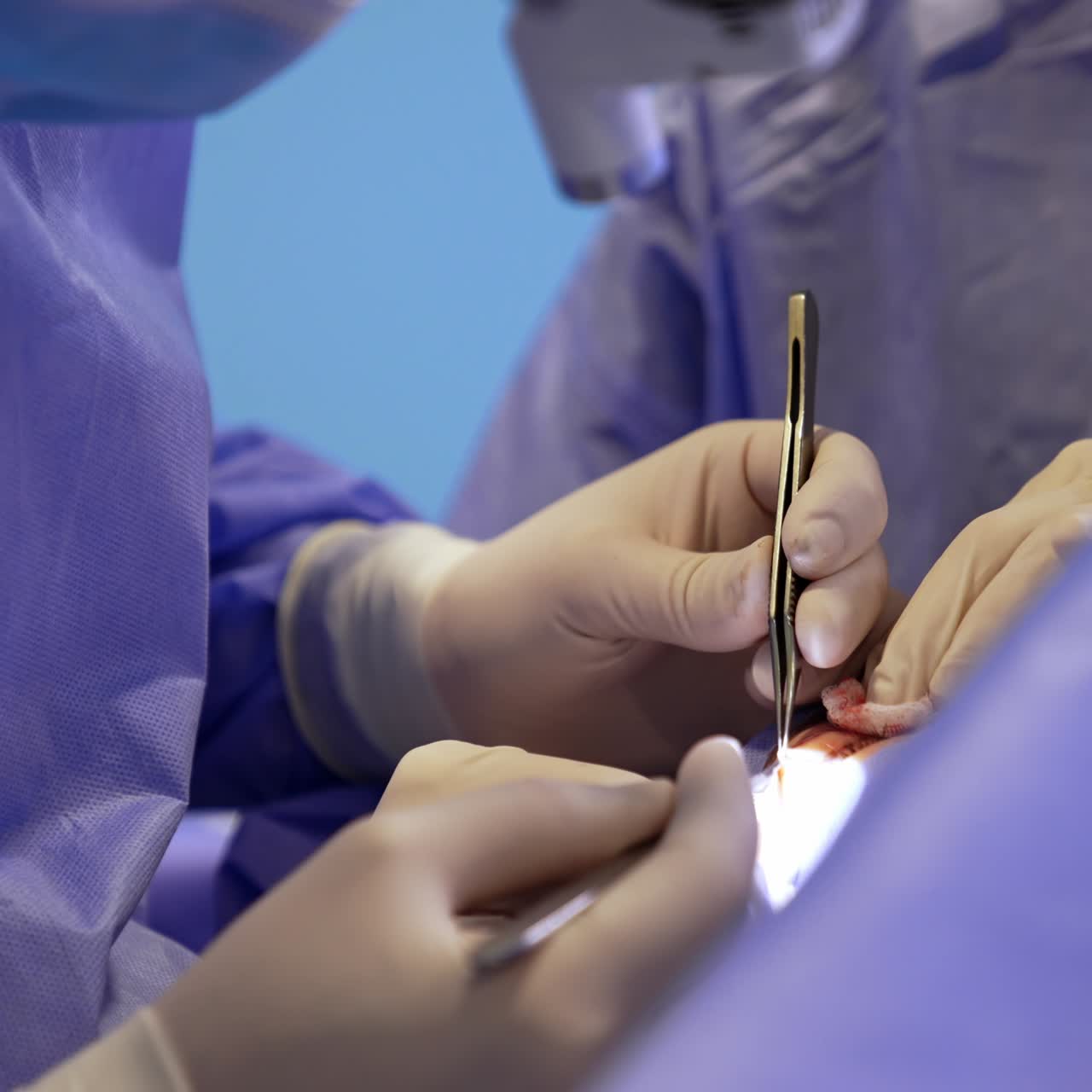 Operation on thyroid in modern clinics. Surgeon carefully uses forceps and scalpel lighting the operational spot with headlight