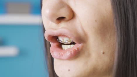 close-up mouth of angry woman with braces.