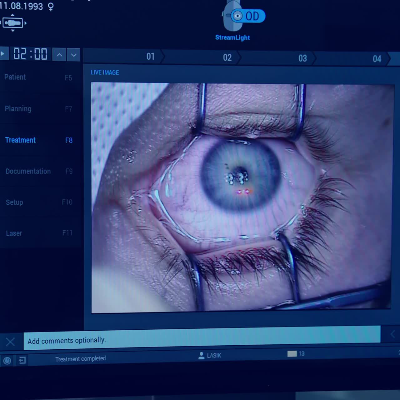 Patient during ophthalmic surgery. Doctor with equipment removes the cyst in the eye