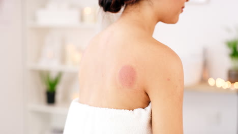 woman receiving cupping therapy at a spa