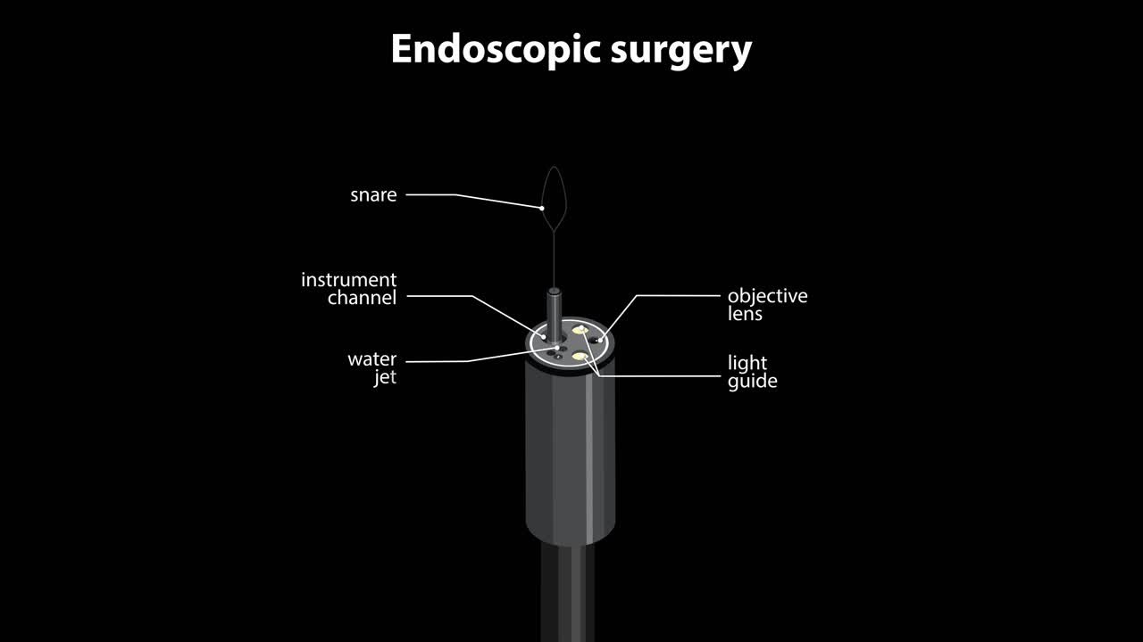 Animated sequence illustrating endoscopic surgery in colon, showing instrument insertion, internal view, and anatomy
