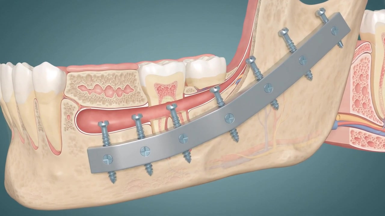 jaw fracture surgery stabilization 3d animation animation