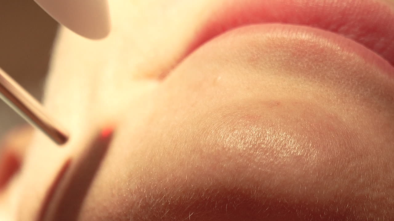 입술 근처의 피부과적 절차의 매크로 영상