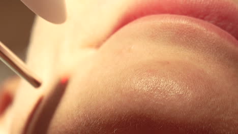 imágenes macro de un procedimiento dermatológico cerca de los labios