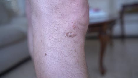 A-viral-wart-on-a-man's-leg