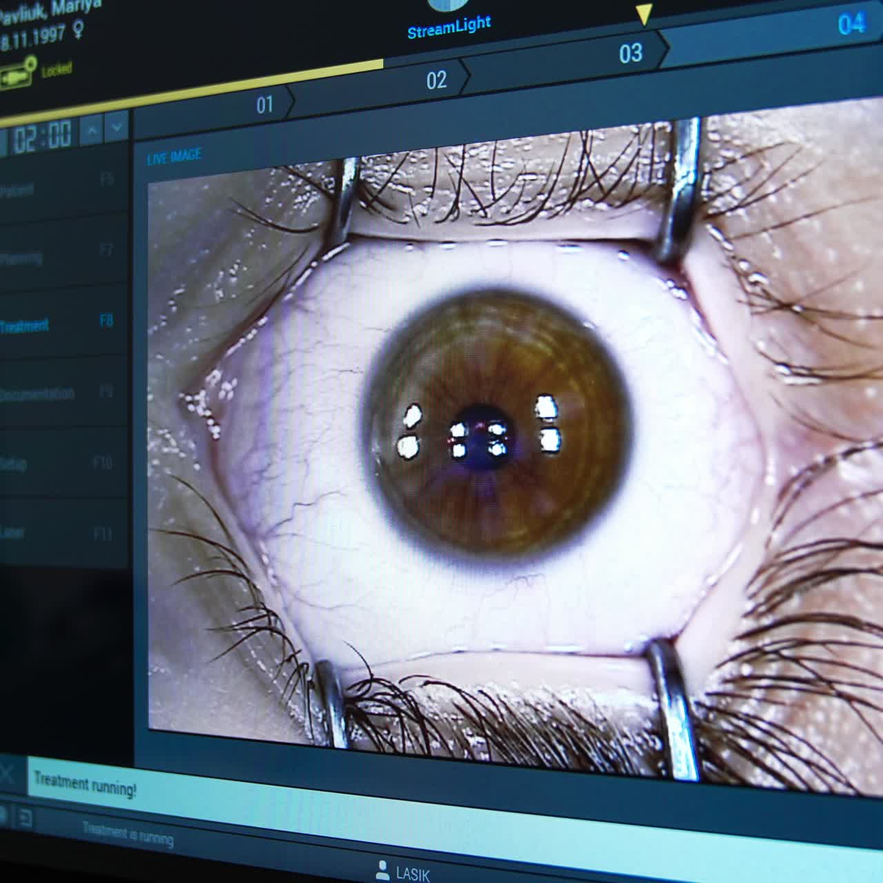 Professional eye laser correction. Medical eyesight operation