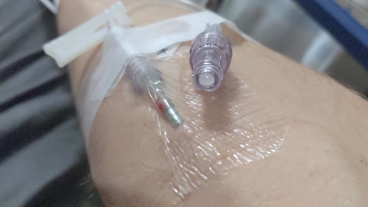 cierre de una vía intravenosa insertada en un brazo derecho masculino no identificable