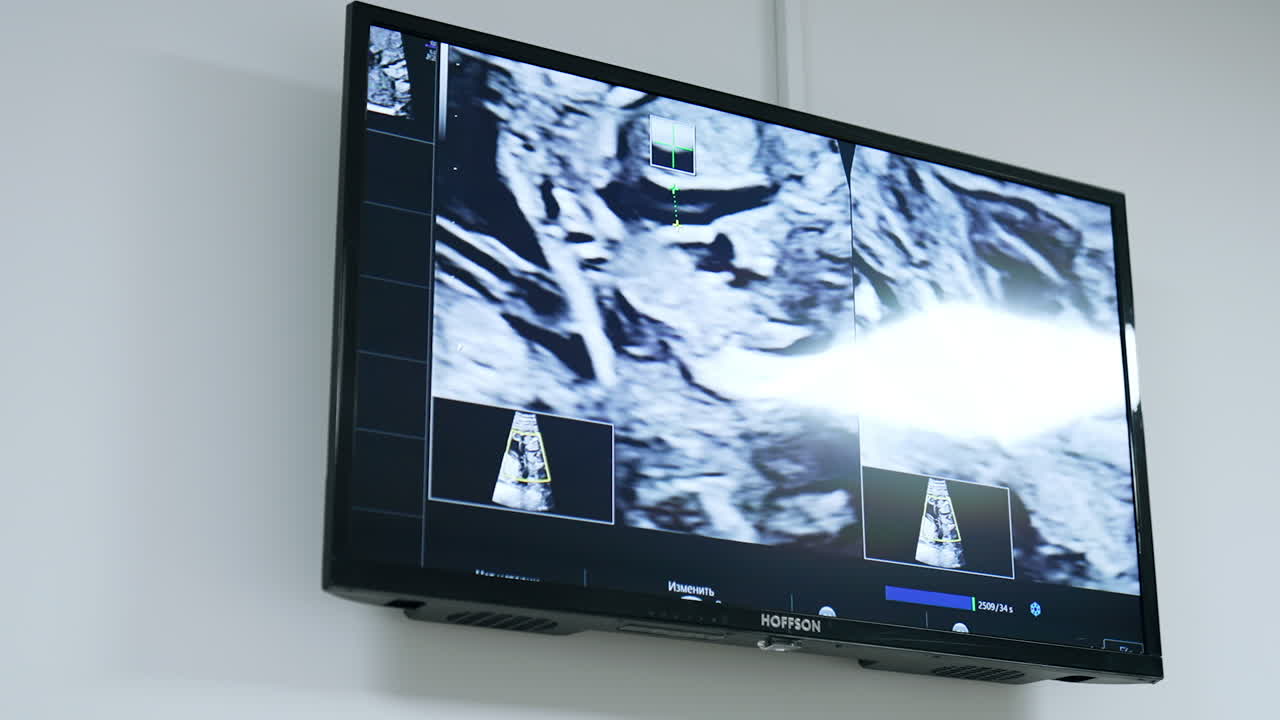 Black and white screen with the image of ultrasound scan. Pregnancy check up at clinics.