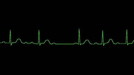 el ecg muestra bloqueo de av de segundo grado mobitz 1