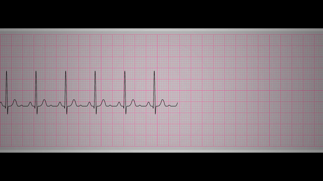 синусовая тахикардия