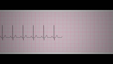 ekg sinus tachycardia