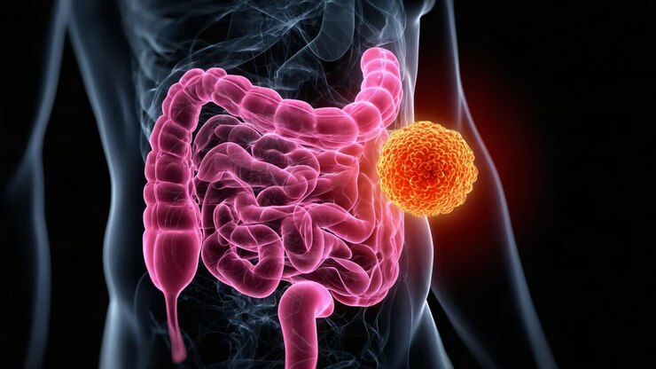 Visual Representation of Digestive System Highlighting Tumor Formation in Intestines, Showcasing the Interaction Between Healthy Organs and Cancer Cells