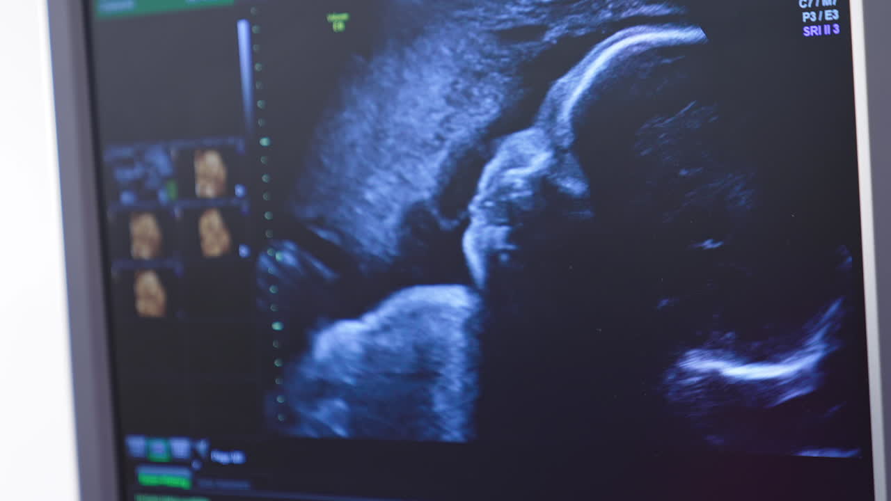 Screen shows a future child on ultrasonography. Baby during ultrasound scan with heartbeat sound. Sonography pregnancy. Fetus check of human embryo. Doctor's hand showing the baby on monitor.