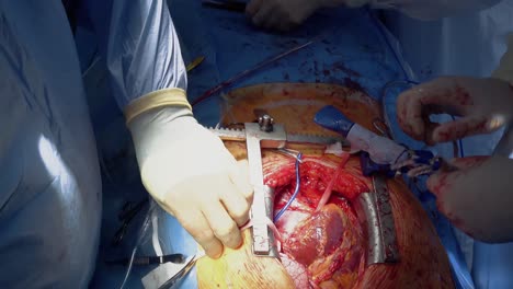 medical staff of the operating unit do heart surgery preparation for the installation of the shunt