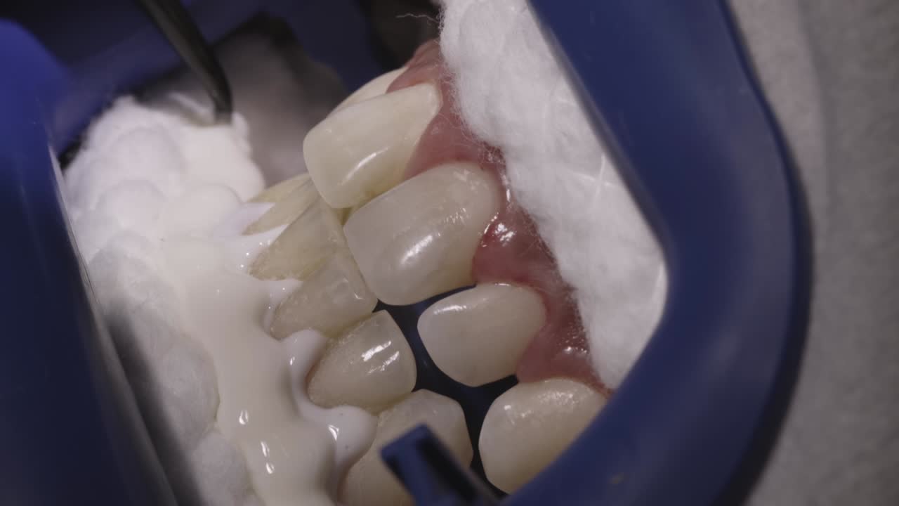 Close up of dental whitening procedure with applicator on patient's teeth