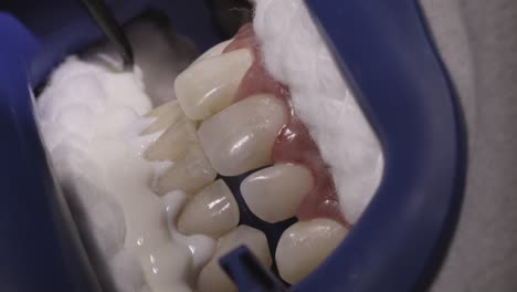 close up of dental whitening procedure with applicator on patient's teeth