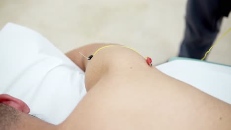 patient laying down having dry acupuncture on his arm, muscle stimulation technic