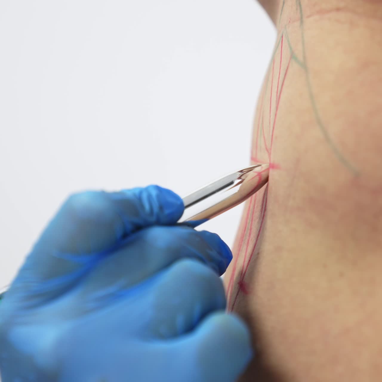Gloved hand of a doctor drawing red and blue lines with a pen. Patient's abdomen being prepared for liposuction surgery