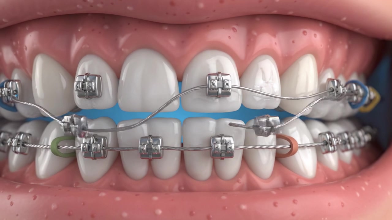 Detailed Visual Representation of Orthodontic Braces on Teeth: A Close-Up View Showcasing Upper and Lower Dental Arches with Brackets and Wires in Focus