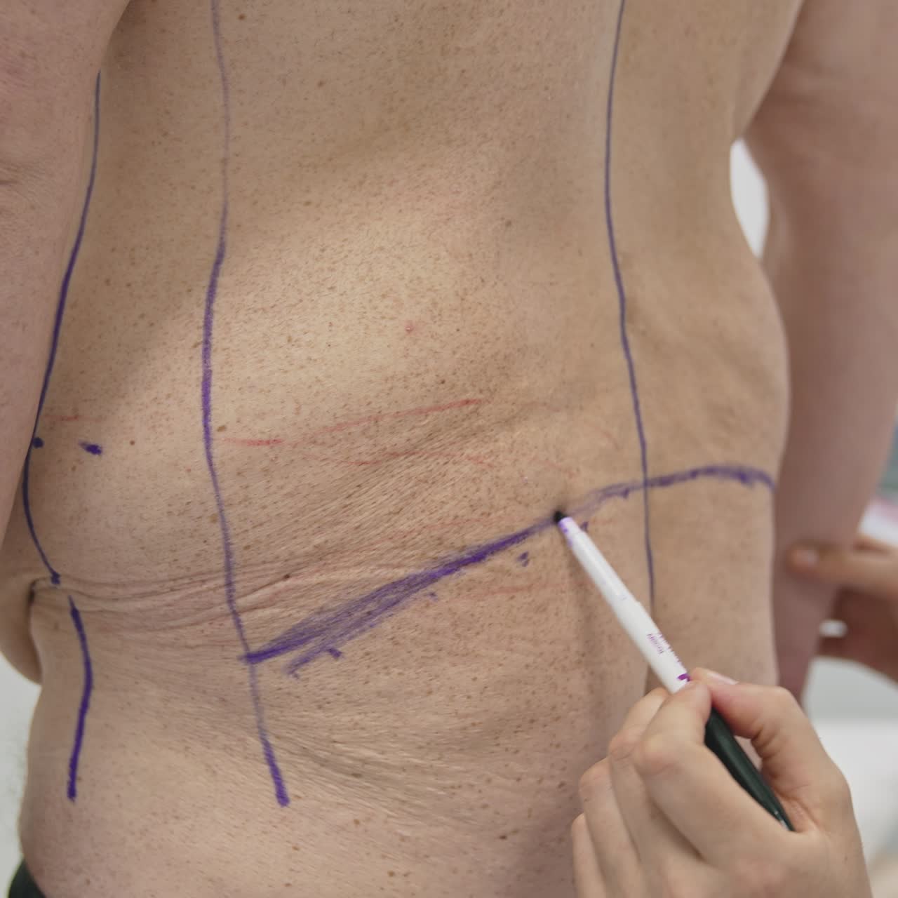 Plastic surgeon prepares a patient for liposuction surgery. Doctor draws lines on the male body with a marker