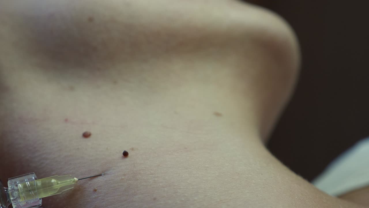 Mole Removal Procedure