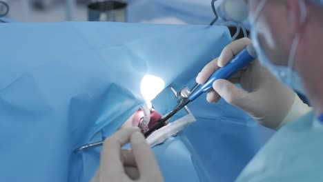 operation to remove tonsils. in modern clinic under deep anesthesia, using latest devices patient removes glands, cold plasma method, cuts swelling in throat, doctor works with new probe, close-up, new medical technologies