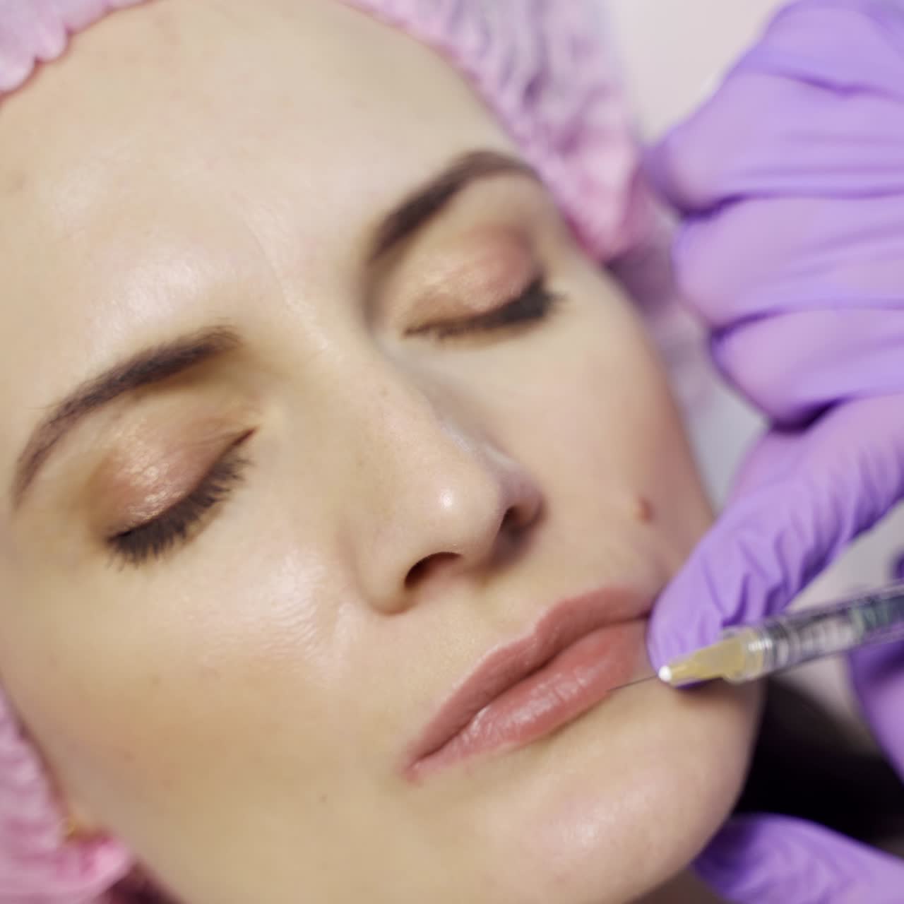 An aesthetic medicine doctor makes Botox to the client's lips. Beauty injections. Cosmetology. Close-up.