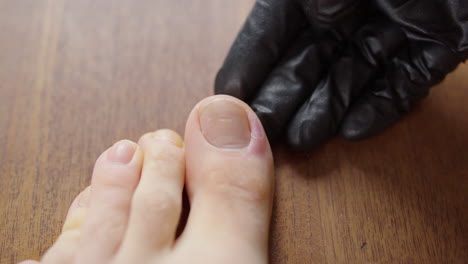 patient's toe infection gets checked by doctor with black glove, close-up on toe