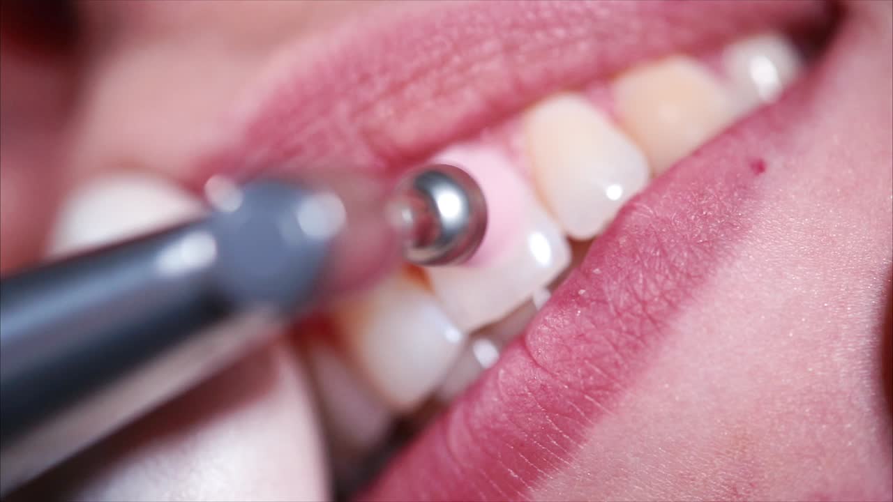 치아 청소 절차