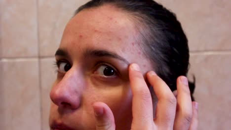 girl with adult acne touching her forehead skin, extreme close up