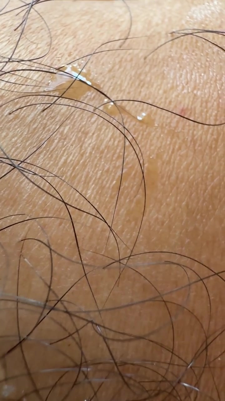 Primo piano di una gocciolina di liquido che si muove sulla pelle umana con peli corporei