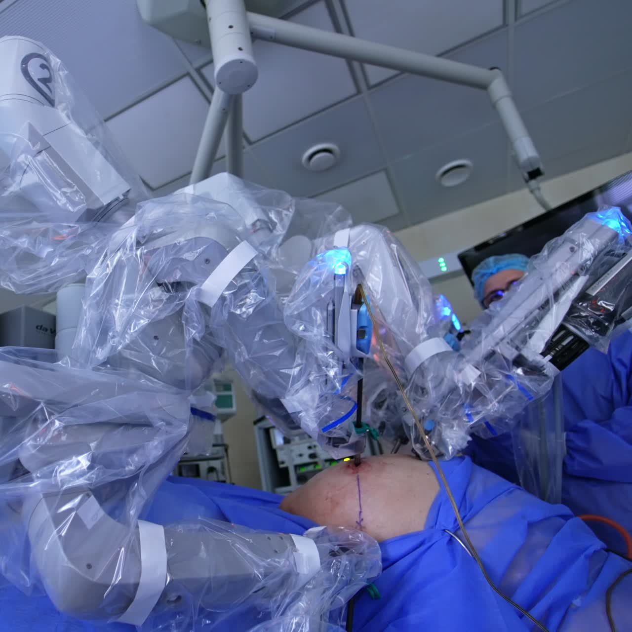 Robotic surgeon performs minimal invasive surgery. Patient's abdomen is operated by modern technology robotic system. Low angle view