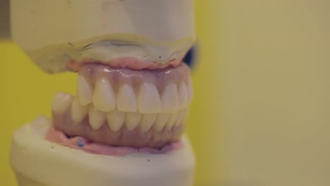 dental prosthetic with upper and lower sets of teeth being adjusted on a dental model