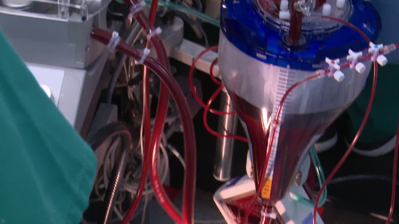 Cardiopulmonary Bypass Machine in an Operating Room