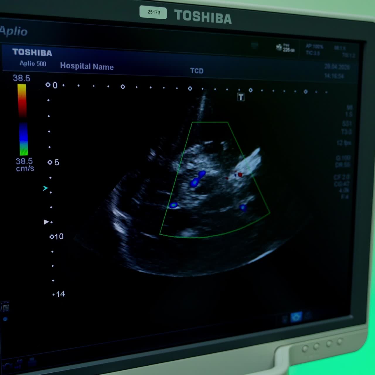 Ultrasound on screen of a computer. Medical monitor shows sick organ of a patient during ultrasound research. Close-up.