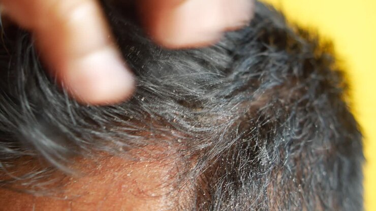 Close-up view of dandruff on a person's scalp