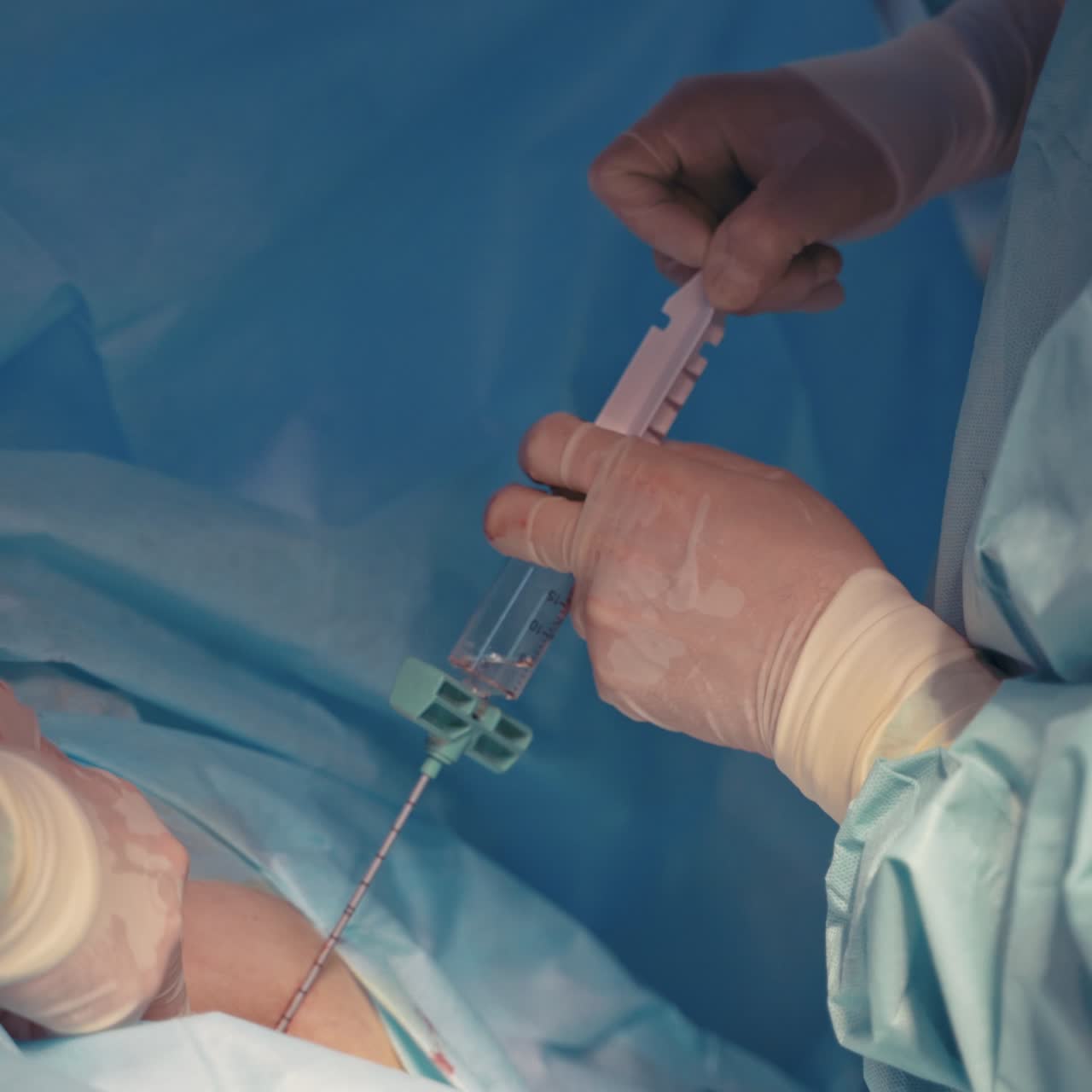 Bone marrow transplant operation