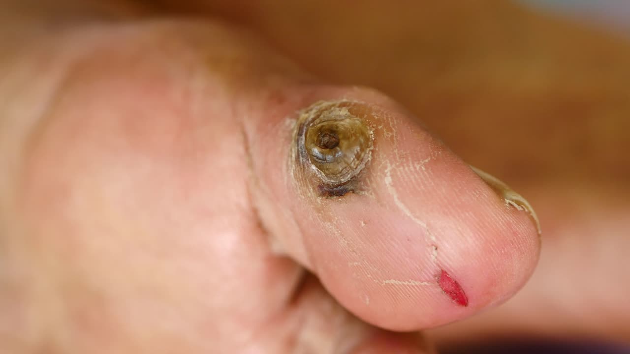 Micosi secca sui piedi di uomini anziani