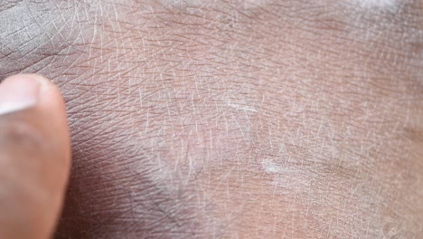 imagen de cerca de la piel seca y picante de una persona en su mano.