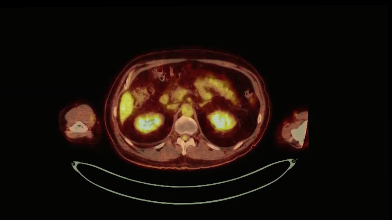 ct (tomografía por emisión de positrones) de todo el cuerpo humano 3d que representa la imagen de tono de color rojo axial para detectar la recurrencia del tumor después de la cirugía.