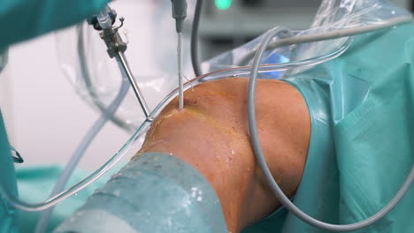 Knee-Arthroscopy--Close-up