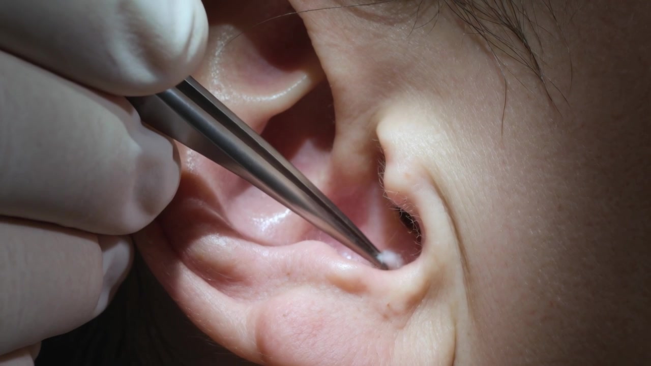 Pulizia dell'orecchio di un bambino in clinica, mentre una mano guantata inserisce delle pinzette, estraendo del cotone sotto una lampada da lavoro.