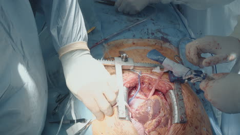 surgeon removes stabilizing device. surgical team performs complicated surgery on heart attaching graft vessels to coronary artery in operating room