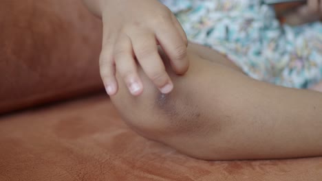 child's knee with bruise or skin discoloration